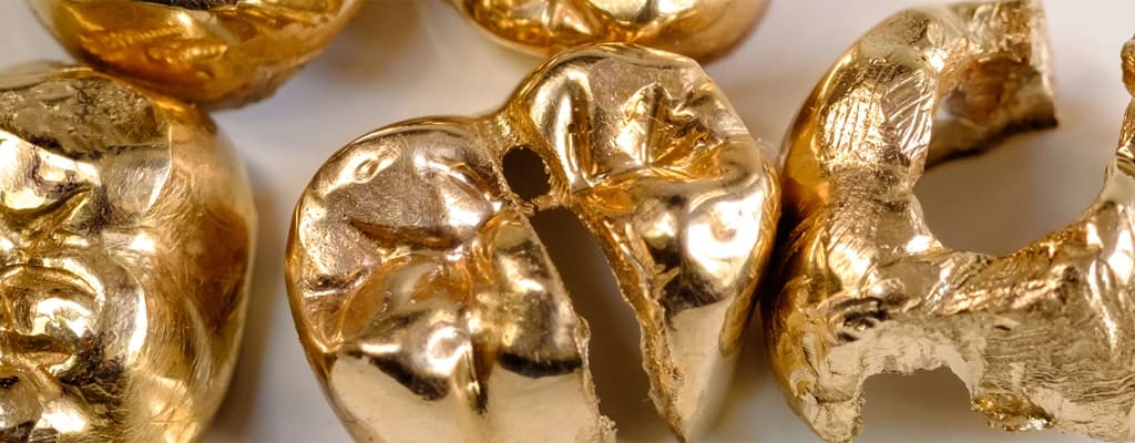 Macro image of extracted gold teeth and crowns, ready for dental gold selling and valuation.