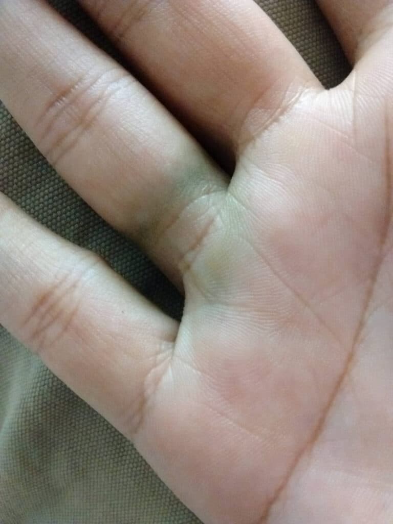 Green stain on skin from gold jewellery, caused by metal alloys like copper reacting with sweat.