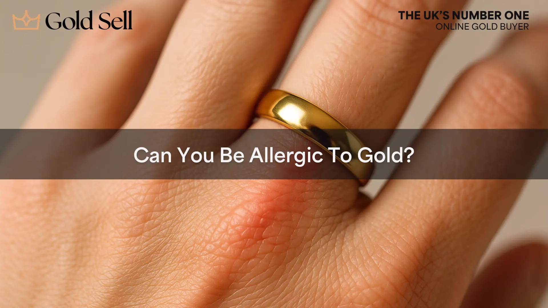 Close-up of a hand with redness under a gold ring illustrating the question can you be allergic to gold and showing visible gold allergy symptoms.
