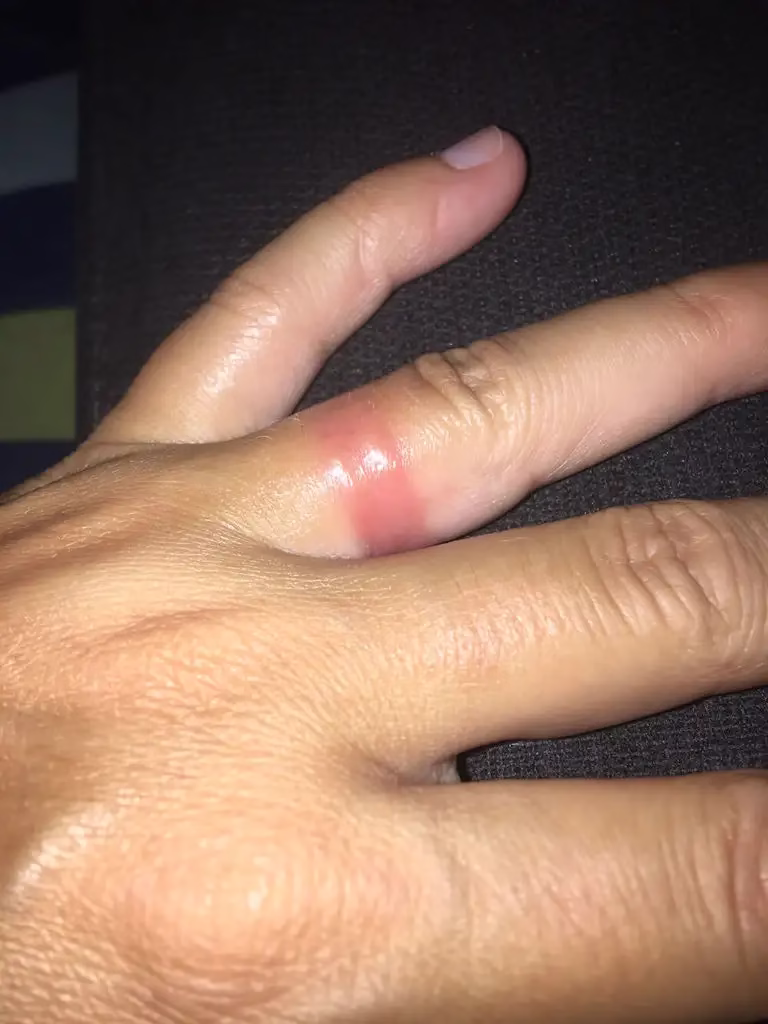 Close-up of a finger showing redness and swelling from a gold allergy reaction, illustrating common gold allergy symptoms such as irritation and skin inflammation.